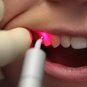 Лазерне відбілювання зубів, доступна вартість в москві