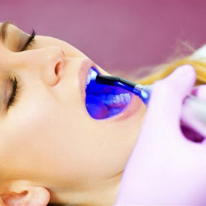 Laser albirea dinților, la prețuri accesibile la Moscova