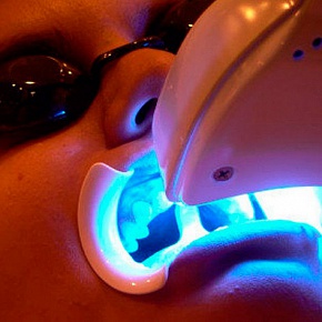 Лазерне відбілювання зубів, доступна вартість в москві