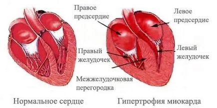 Лікування гіпертрофії лівого шлуночка серця народними засобами - рекомендації по дієті і ін -