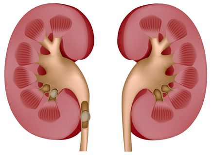 Tratamentul pietrelor de rinichi cu suc de lamaie - boala renală - boli interne - lista bolilor
