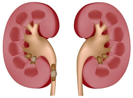 A kezelés a vesekő citromlével - vesebetegség - belgyógyászat - a betegségek listája