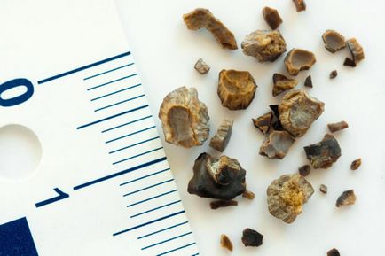 Лікування каменів у нирках народними засобами, столітник