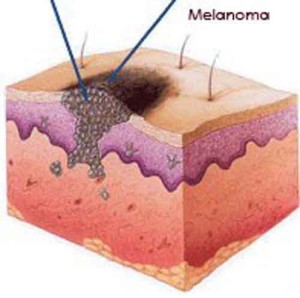 A melanoma kezelésében a metasztázisok