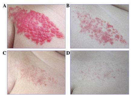 Tratamentul sugarilor cu hemangiomas timolol, hemangiom