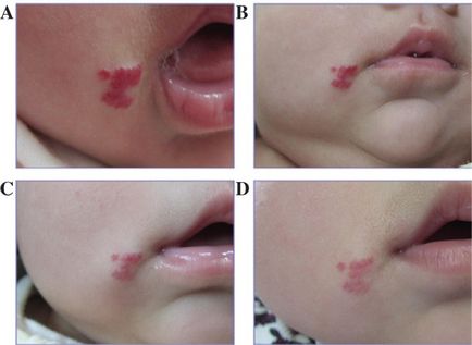 Tratamentul sugarilor cu hemangiomas timolol, hemangiom