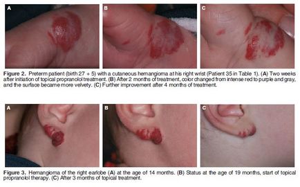 Tratamentul sugarilor cu hemangiomas timolol, hemangiom