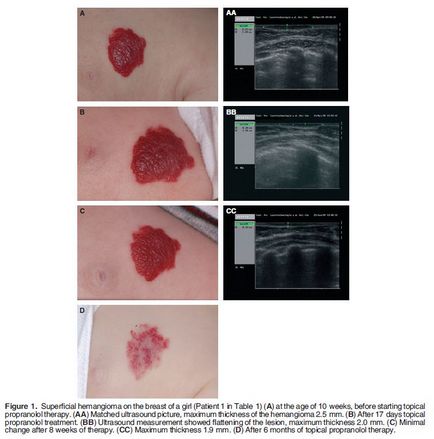 Tratamentul sugarilor cu hemangiomas timolol, hemangiom