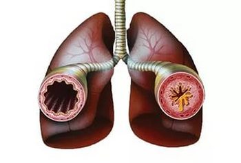 Лікування муміём - бронхіальна астма