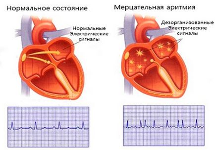 Лікування народними засобами миготливої ​​аритмії рекомендації