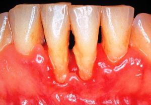 Лікування пародонтиту народними методами