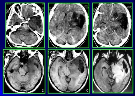 Tratamentul de chimioterapie creier astrocitom, radioterapie, chirurgie