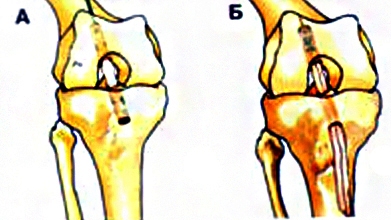 Tratamentul rupturii ligamentelor articulației genunchiului în străinătate - medicină a lumii