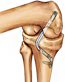 Tratamentul rupturii ligamentelor articulației genunchiului în străinătate - medicină a lumii