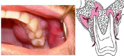 Tratamentul inflamației periostului dintelui