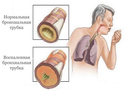 Tratamentul bronșitei cronice - ce și cum trebuie tratat, dispozitivele medicale