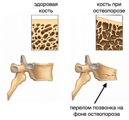 Кращі безпечні препарати 2015 для лікування остеопорозу