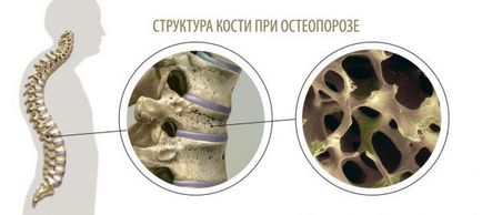 Cele mai bune preparate sigure din 2015 pentru tratamentul osteoporozei