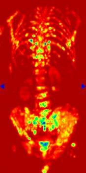 Melanomul - metastazele melanomului sunt etape importante în tratamentul melanomului și a metastazelor melanomului