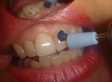 Метод мікроабразії в естетичній стоматології