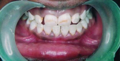 Метод мікроабразії в естетичній стоматології