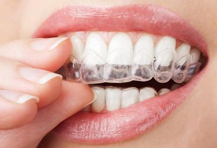 Microabraziunea smalțului dinților - albire progresivă