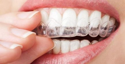 Microabraziunea smalțului dinților - albire progresivă