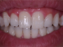 Мікроабразія - методика видалення білих плям на зубах