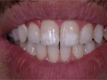Microabraziunea - o tehnică pentru îndepărtarea petelor albe pe dinți