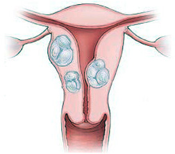 Miomul uterului tratat chirurgical - clinica biljak