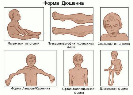 М'язова дистрофія - характеристика патології