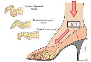 Молоткообразная деформація пальців стопи на ногах