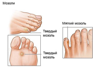 Молоткообразная деформація пальців стопи на ногах