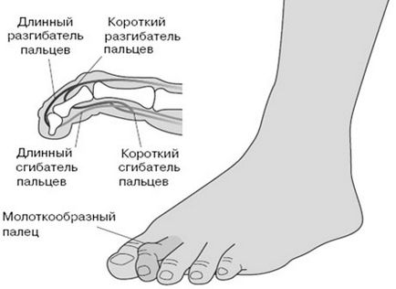Deformarea în formă de ciocan a degetelor de la picioare