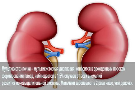 Diagnosticul și tratamentul bolii rinichiului multi-chistic