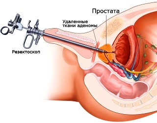 Чоловік простатит