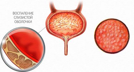 Népi kezelésére cystitis férfiaknál