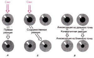 Порушення зіничних реакцій причини, симптоми, прояви