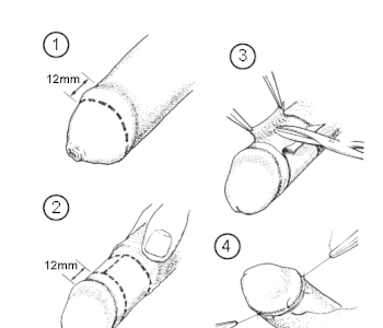Обрізання у дорослих причини і мета операції, плюси і мінуси