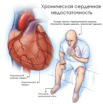 Dispneea cu insuficiență cardiacă prim ajutor, cauze și metode de tratament