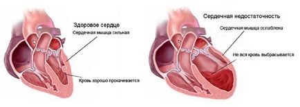 Dispneea cu insuficiență cardiacă prim ajutor, cauze și metode de tratament