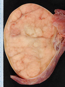 Testicule testiculare - clinică (simptome), diagnostic, tratament, profilaxie și prognostic