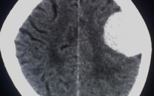 Пухлина лобної ділянки головного мозку