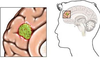 Semnele principale ale astrocitomului creierului