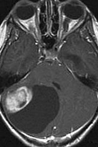 Semnele principale ale astrocitomului creierului