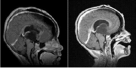 A fő tünetek agyi asztrocitóma (agyi astrocytoma) A fő tünetek az agy astrocytoma