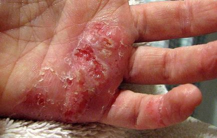 Eczemă acută, tratament subacut de geneză diferită, prevenire
