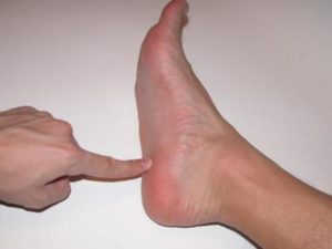Depunerea sărurilor în simptomele călcâiului și tratamentul picioarelor calcaneale