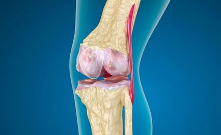 Artroza patellofemorală a articulației genunchiului