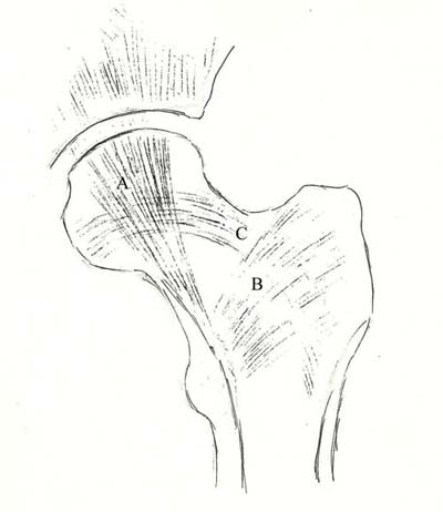 Fracturile gâtului femural și clasificarea pazei, traumatologie pentru toți
